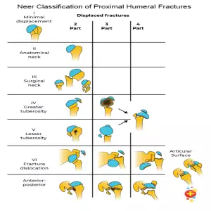 Neer classification of proximal humeral fractures